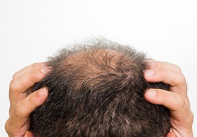 Hair Restoration Surgery with Minimal Cost