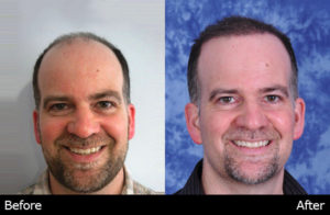 Image of a before & after patient who received a hair transplant