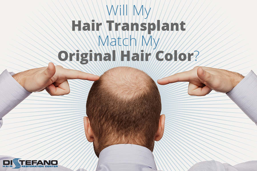 A man pointing to his balding head with the words 'How Well Do Hair Transplants Match Original Hair Color'