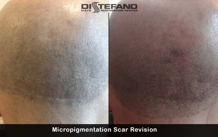 scar revision