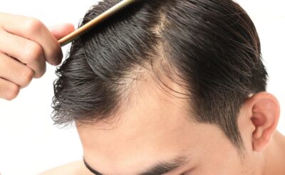 How to Care for Thinning Hair - Hair Transplants & Hair Loss Restoration in  CT, MA, RI & NH