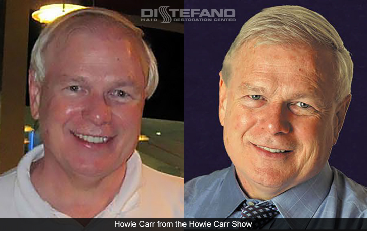 Howie Carr Before and After DiStefano Hair Transplant