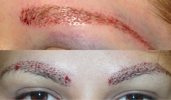 eyebrow restoration process 2nd step