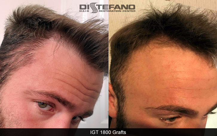 Gallery: Real Patient Results - Hair Transplants & Hair Loss Restoration in  CT, MA, RI & NH