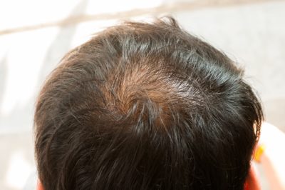 How to Combat Thinning Hair - Hair Transplants & Hair Loss Restoration in  CT, MA, RI & NH