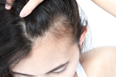 What Causes Teenage Hair Loss? - Hair Transplants & Hair Loss Restoration  in CT, MA, RI & NH