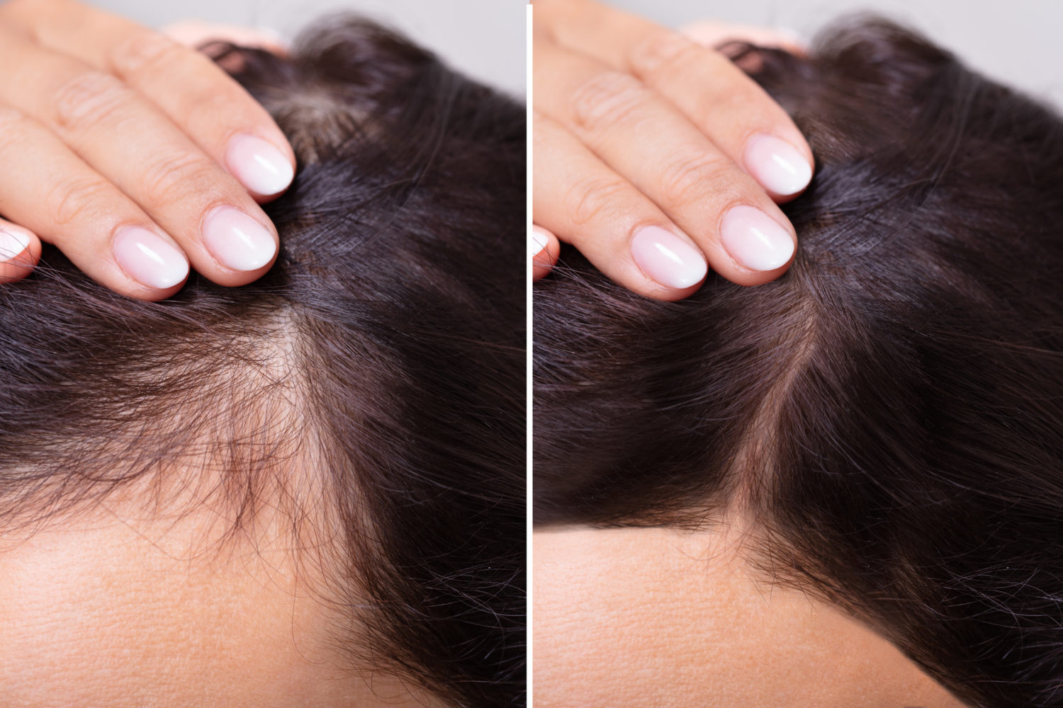 women's hair loss treatment before and after