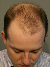Men's Hair Replacement