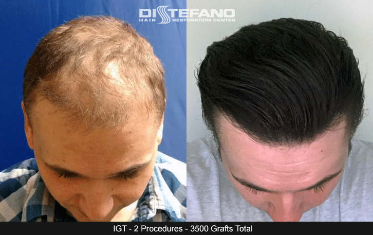 Gallery: Real Patient Results - Hair Transplants & Hair Loss Restoration in  CT, MA, RI & NH