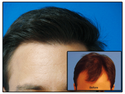 Am I a Candidate for a Hair Transplant? - Hair Transplants & Hair Loss  Restoration in CT, MA, RI & NH
