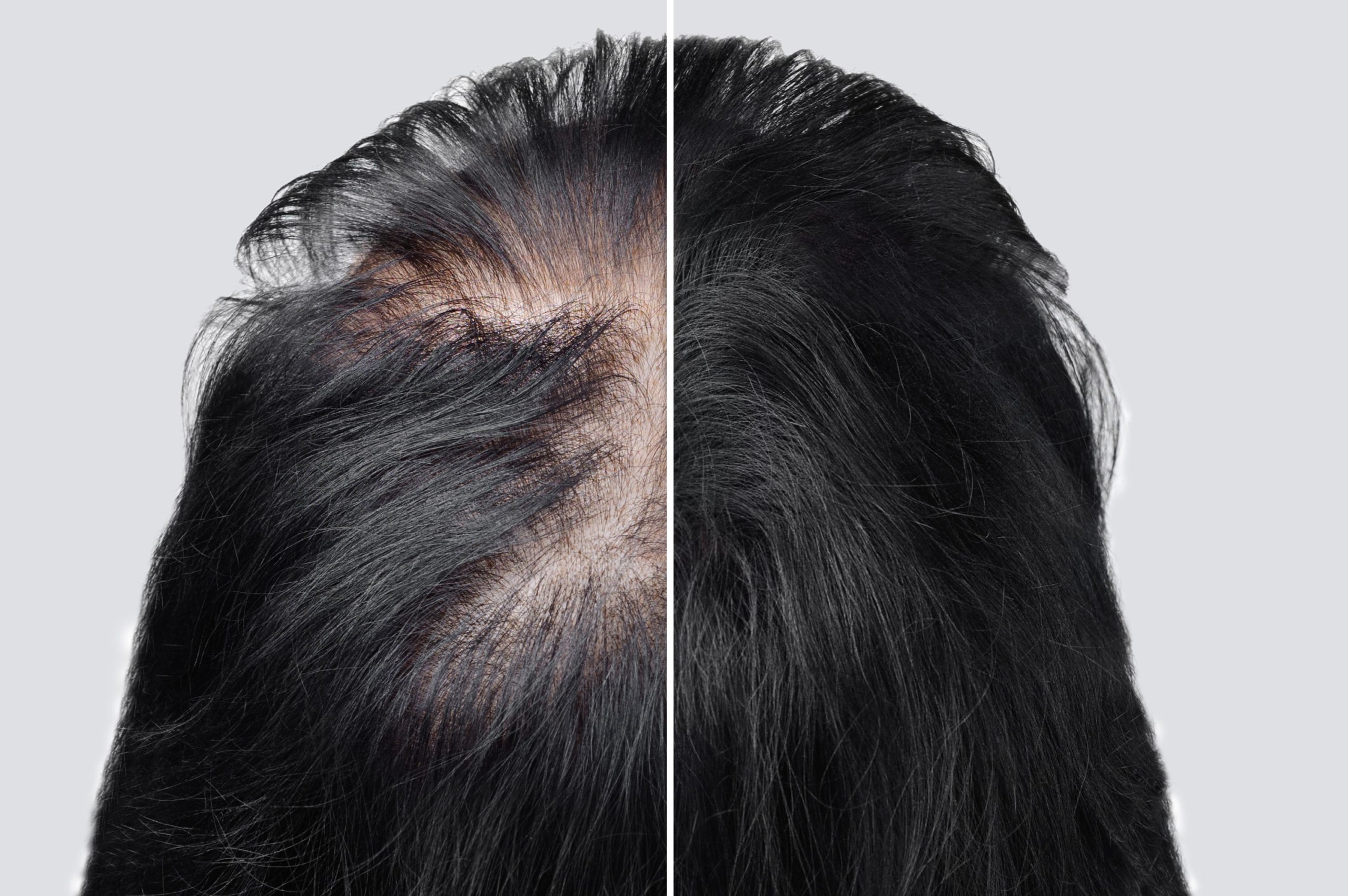 Stages of Hair Loss - HairMax UK
