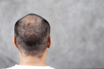 How Your Age Impacts Hair Loss - Hair Transplants & Hair Loss Restoration  in CT, MA, RI & NH