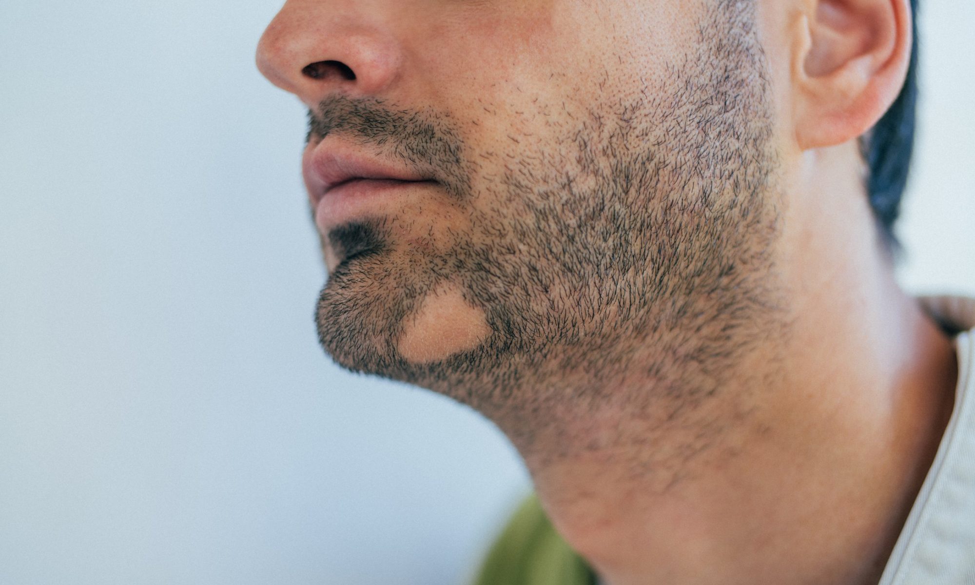 Алопеция у мужчин на бороде