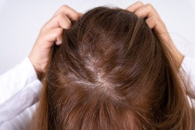 Hair Loss in Middle-Aged Women - Hair Transplants & Hair Loss Restoration  in CT, MA, RI & NH