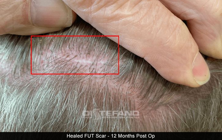 healed scar after FUT hair transplant