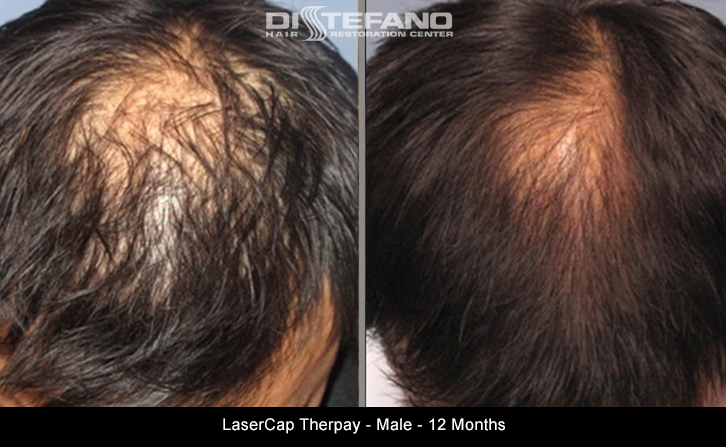 Low Level Laser Therapy Products - Hair Transplants & Hair Loss Restoration  in CT, MA, RI & NH
